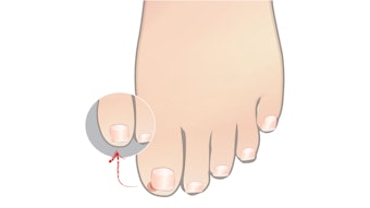 Ingrown toenails are a common issue in the salon. While techs are not permitted to treat this condition, nail pros can help prevent ingrown toenails.
