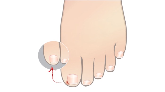 Ingrown toenails are a common issue in the salon. While techs are not permitted to treat this condition, nail pros can help prevent ingrown toenails.