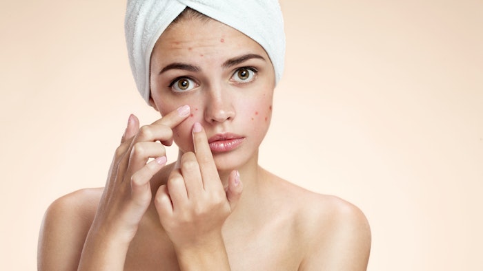 Acne spot pimple spot skincare beauty care girl
