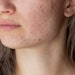 Cropped shot of a young woman's face with the problem of acne.