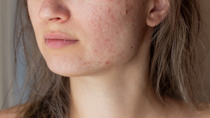 Cropped shot of a young woman's face with the problem of acne.