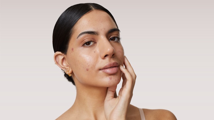 Acne Masterclass