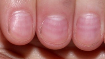 The moons, or lunulae, can be affected by health, age, nutrition, changes in body chemistry and prescription medications.