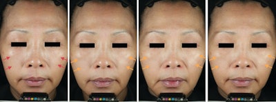 Example of Visia-CR images for one particular subject; from left: untreated (day 0), 3% active formulation (day 1), 3% active formulation (week 2) and 3% active formulation (week 4).
