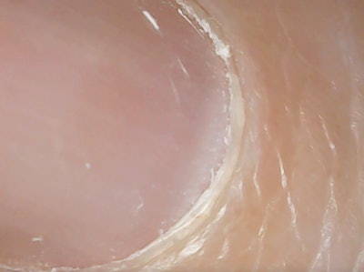 Non Living Tissue Revealed After Pushing Back