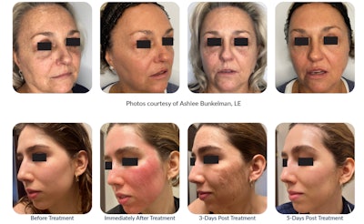 One of the standout features of Reverse by Aerolase is its preventative capabilities.