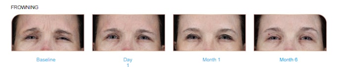 Before and after of Relfydess treating frown lines.