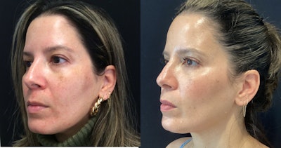 Unretouched before and after photos of Kim Nichols, MD, FAAD patient following eight months of GLP-1 medication and monthly Hydrafacial treatments.