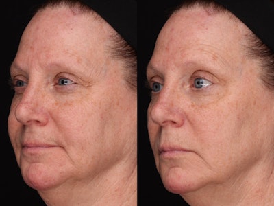 Case 2a: Full face squint/smile.