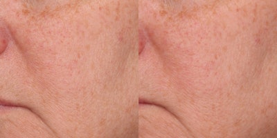 Case 3b (close crop): In this case, notice the subtle changes in the appearance of the skin’s texture and the pores. It’s just function of focus, and there is no mechanical change occurring here.