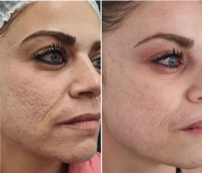 Neo® and Era® devices — clinically proven to treat active acne, eliminate causative factors, and address the lasting effects of pigmentation and scarring.