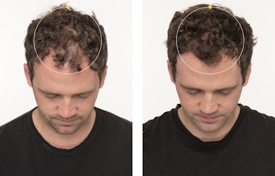 Nutrafol's Men Hair Growth Neutraceutical is a clinically proven, daily hair growth supplement that targets key root causes of thinning in men 18+ for visibly thicker, fuller hair growth and scalp coverage.