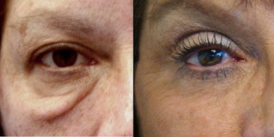 Clincal research of Neo Elite: Post-blepharoplasty
