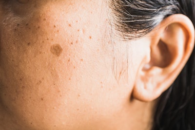 According to Lipoid Kosmetik AG, BakuLipid has been proven to outperform bakuchiol in vivo, effectively targeting blemishes and signs of aging.