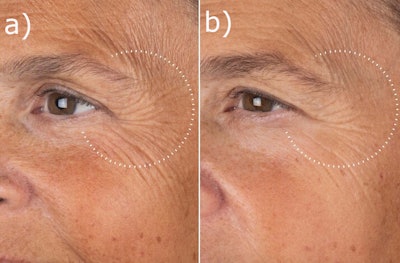 Medik8’s Liquid Peptides Advanced MP Serum is clinically proven to improve the look of deep-set wrinkles; a) before treatment; b) after 8 weeks of treatment