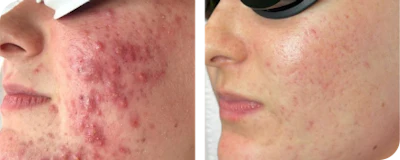 Active Acne