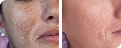Melasma