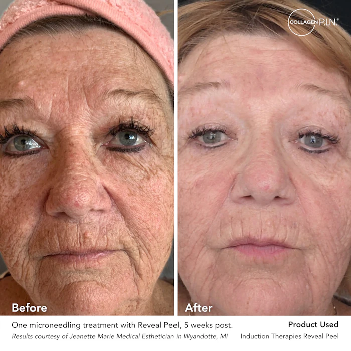 Results Courtesy Of Jeanette Marie Medical Esthetician In Wyandotte Mi